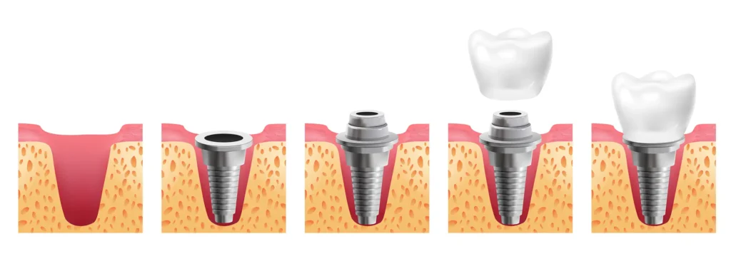 Estágios de Instalação dos Implantes Dentários na Oral Sin Implantes